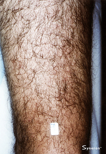 Before Leg Hair Removal